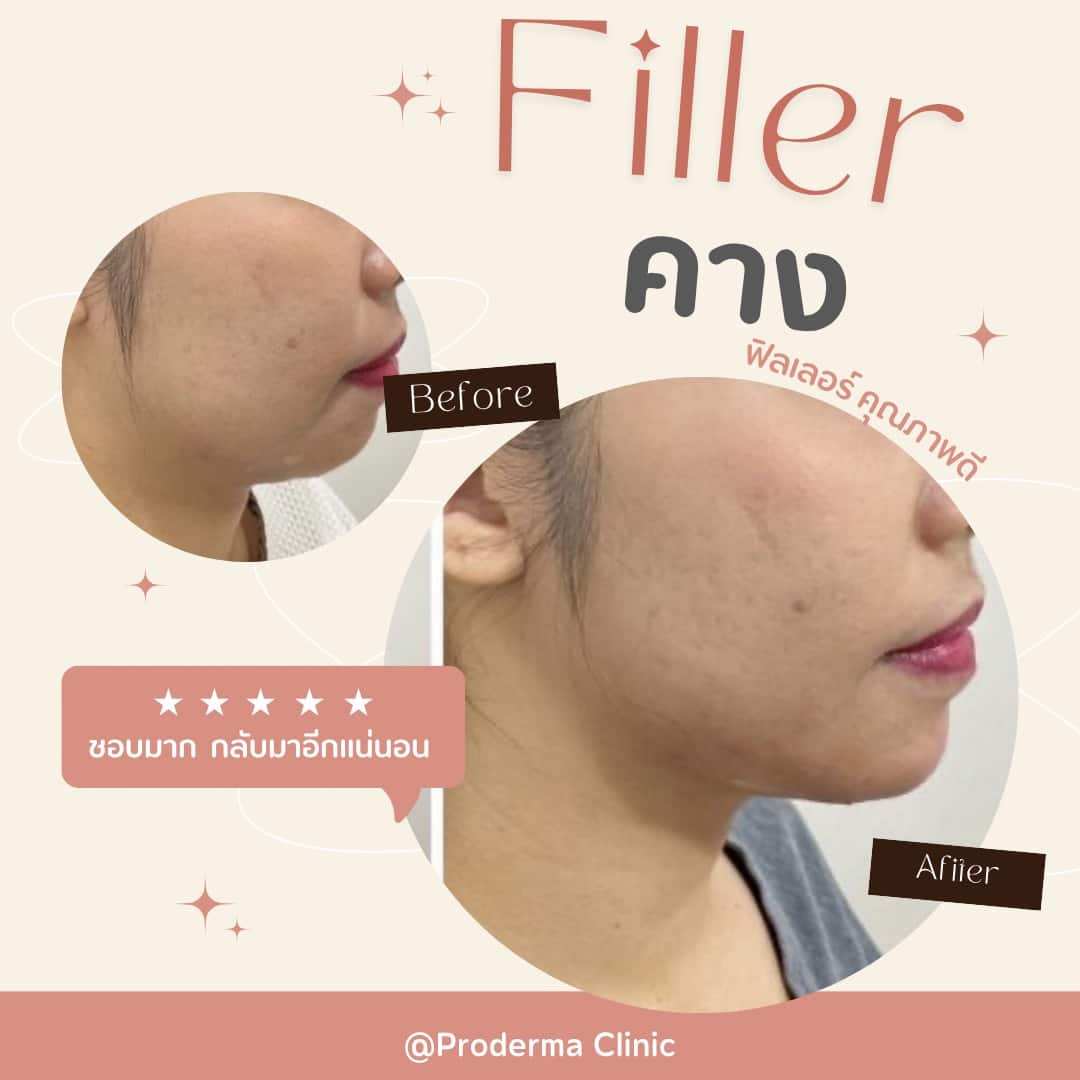 ฟิลเลอร์คาง ปรับรูปหน้า