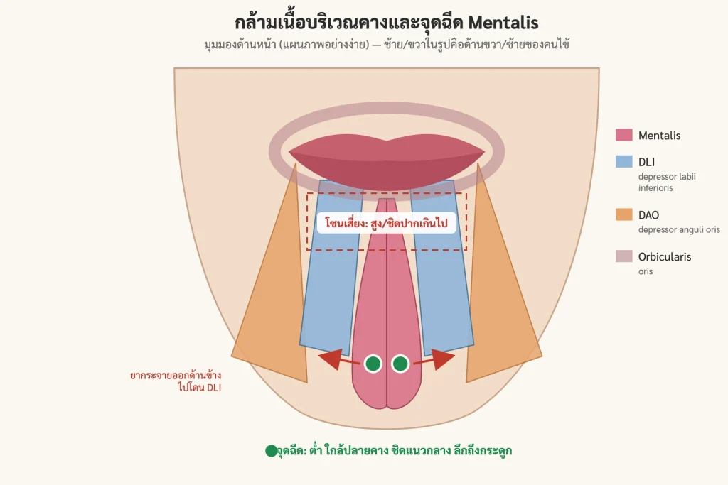 แผนภาพกล้ามเนื้อคาง mentalis DLI DAO และจุดฉีดโบท็อกซ์คาง