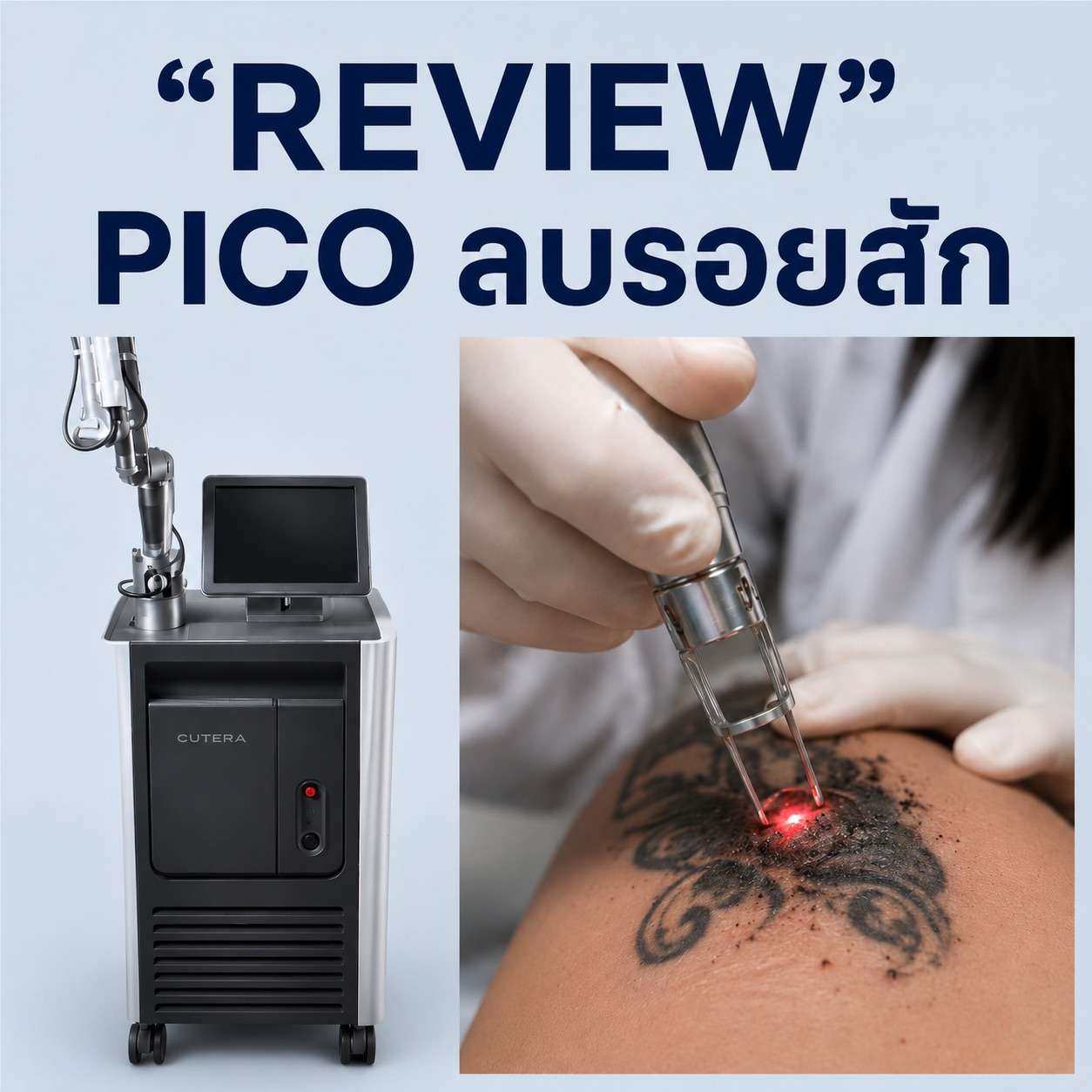 pico ลบรอยสัก ยิงแสงเลเซอร์พลังงานสูงเพื่อสลายอนุภาคหมึกลบรอยสัก