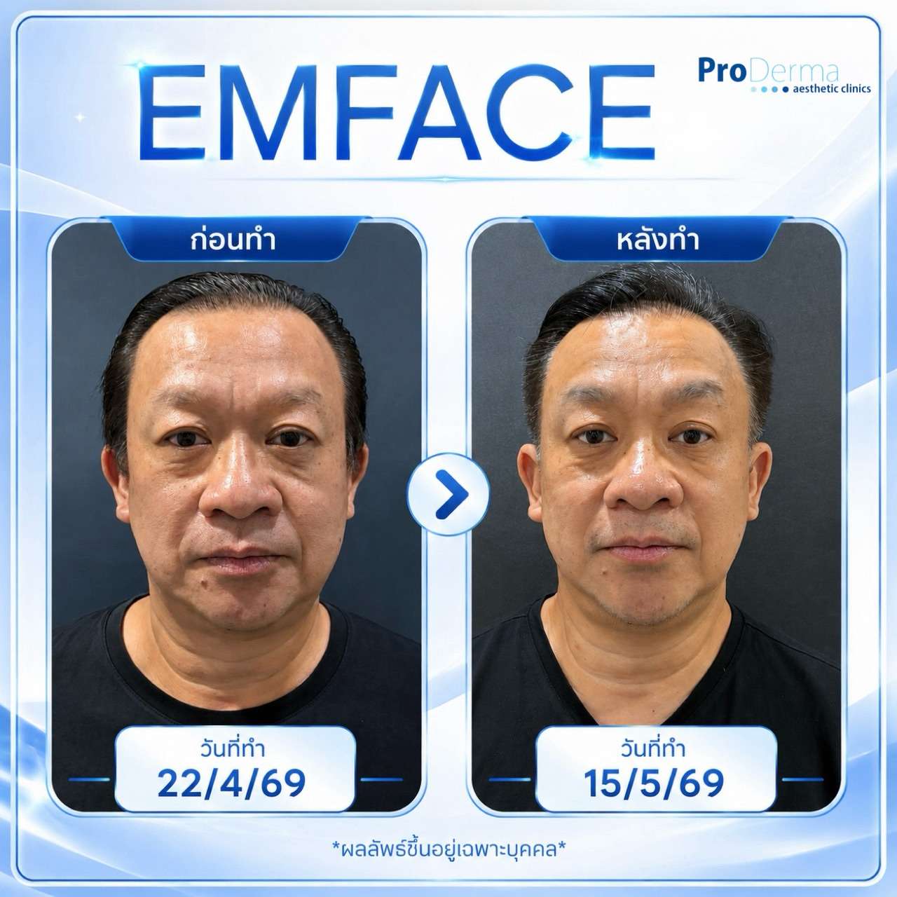 emface ก่อนหลัง ยกกระชับผิวหน้า ลดริ้วรอย ร่องแก้มตื้นขึ้น โดยไม่ต้องผ่าตัด ProDerma Clinic