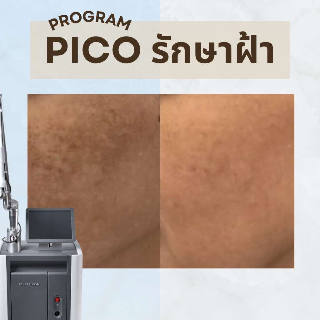 pico ฝ้า