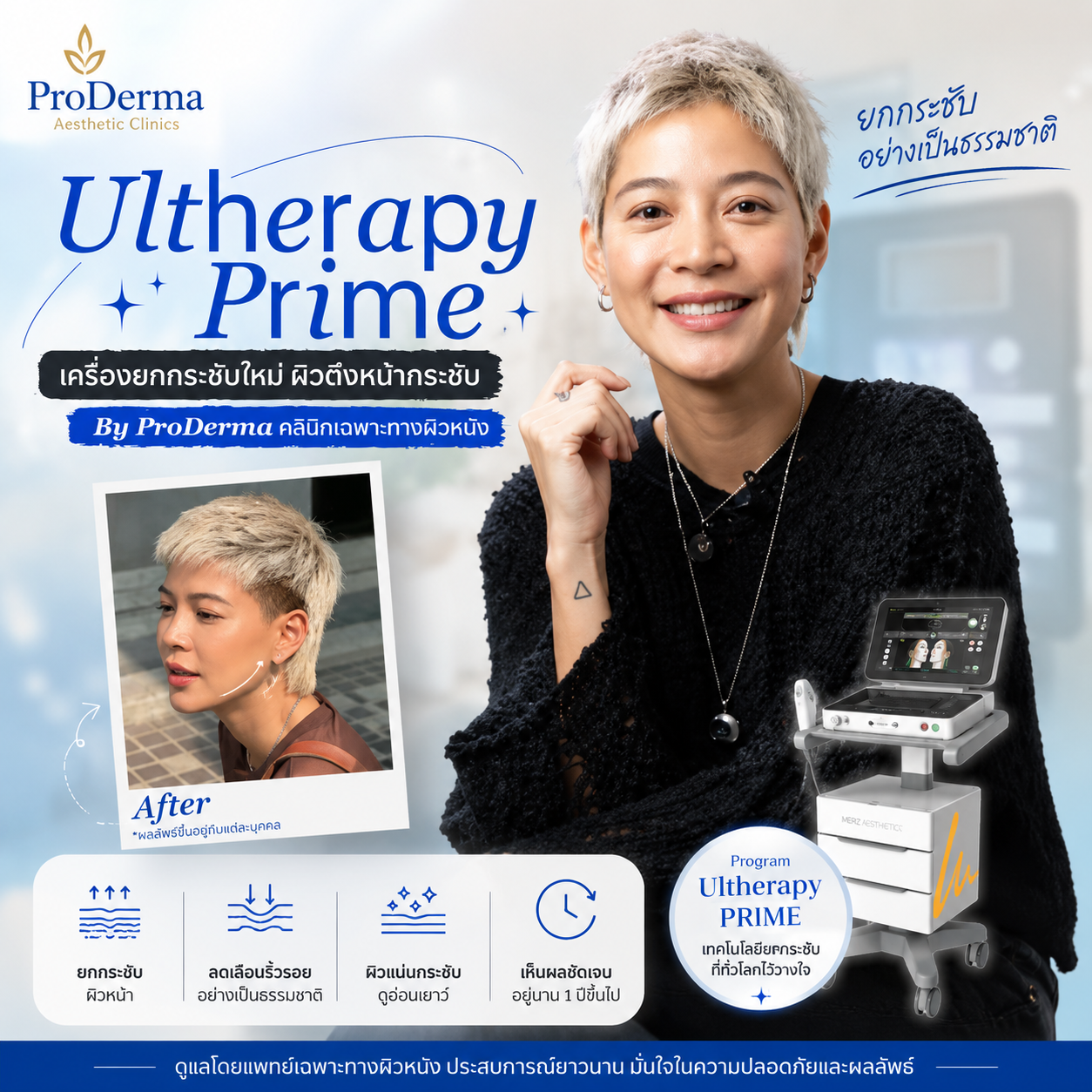 Ultherapy PRIME รีวิว เคสคุณสายป่าน ก่อน–หลังยกกระชับหน้า